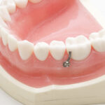 港区（三田・赤羽橋）の矯正歯科専門医院、矯正歯科クリニック三田赤羽橋で矯正治療でインプラント矯正について解説