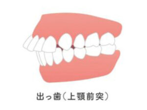 港区（三田・赤羽橋）の矯正歯科専門医院、矯正歯科クリニック三田赤羽橋で矯正治療でインプラント矯正について解説