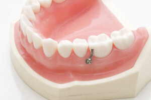 港区（三田・赤羽橋）の矯正歯科専門医院、矯正歯科クリニック三田赤羽橋で矯正治療でインプラント矯正について解説