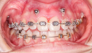 港区（三田・赤羽橋）の矯正歯科専門医院、矯正歯科クリニック三田赤羽橋で矯正治療でインプラント矯正について解説