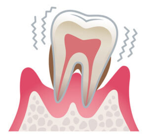 港区（三田・赤羽橋）の矯正歯科専門医院、矯正歯科クリニック三田赤羽橋で矯正治療で矯正中に歯がグラグラする原因について解説