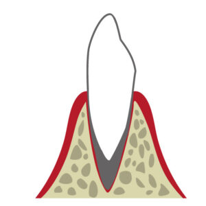 港区（三田・赤羽橋）の矯正歯科専門医院、矯正歯科クリニック三田赤羽橋で矯正治療中の歯根吸収のリスクと進行を防ぐ対策を解説